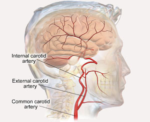 carotid artery disease