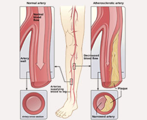 venous disease