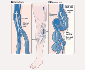 venous disease